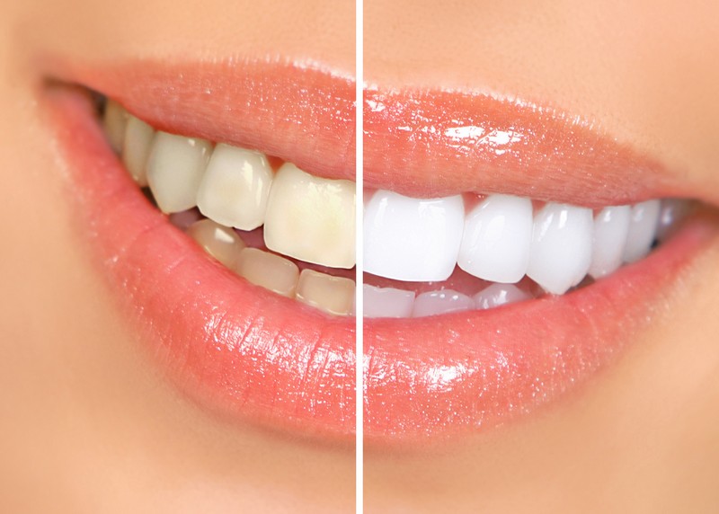 teeth whitening services in Bolingbrook, IL
