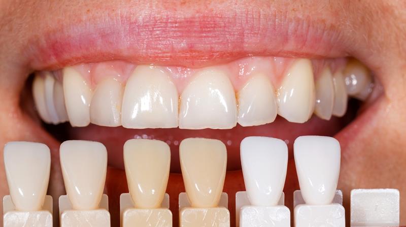 Veneers in Bolingbrook, IL